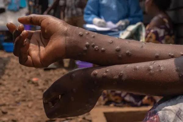 Variole du singe : La Guinée face à l’épreuve d’une épidémie silencieuse (comprendre, prévenir et répondre à une menace virale croissante) — par Dr Karamo Kaba